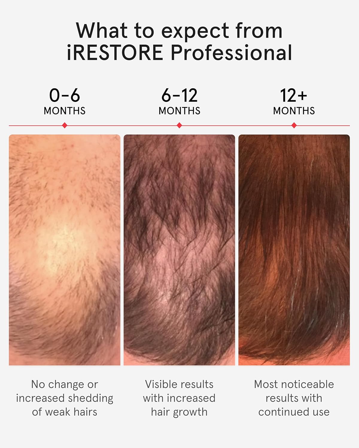 Unlock Your Hair's Potential: The iRestore Pro with 282 Laser and LED Beams for Ultimate Hair Restoration