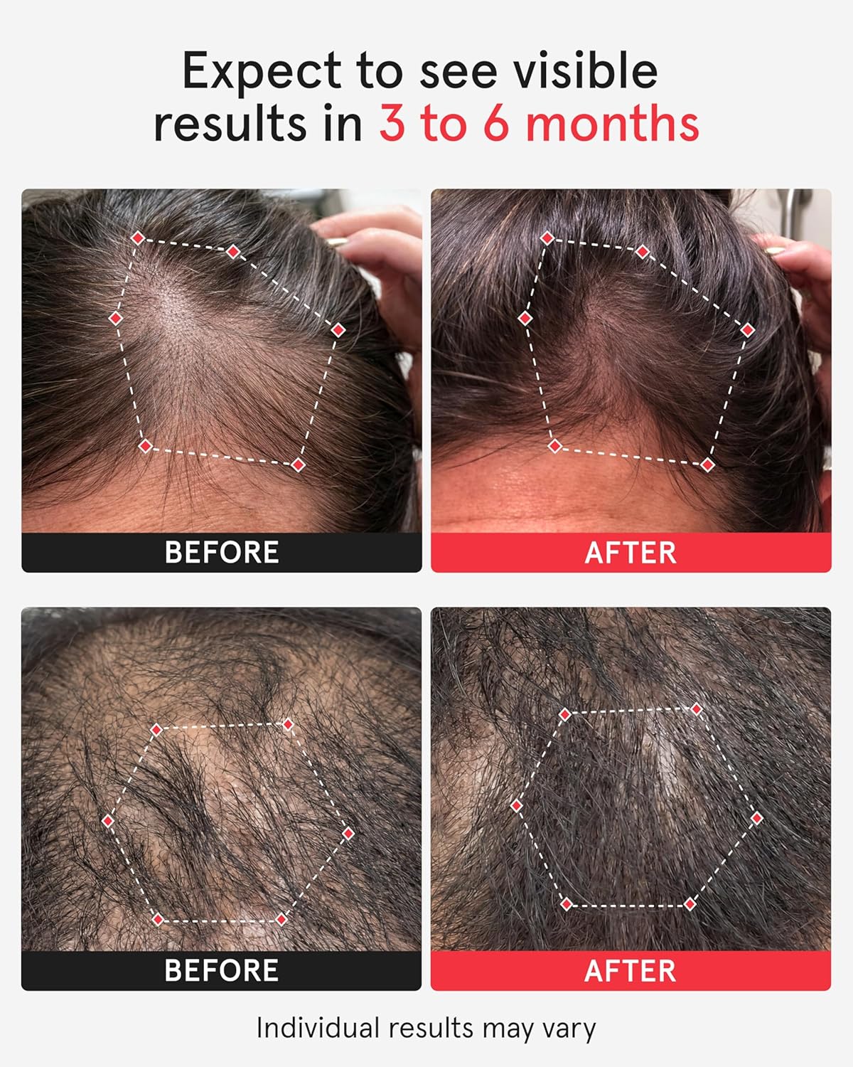Unlock Your Hair's Potential: The iRestore Pro with 282 Laser and LED Beams for Ultimate Hair Restoration