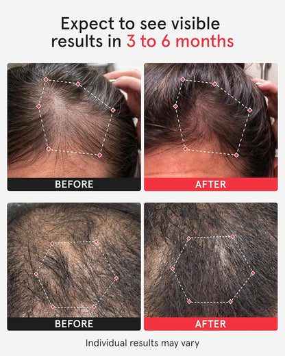 Unlock Your Hair's Potential: The iRestore Pro with 282 Laser and LED Beams for Ultimate Hair Restoration